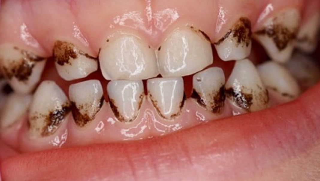 Что такое зубной налет, каким он бывает