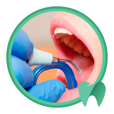 Ультразвуковое удаление твердых зубных отложений