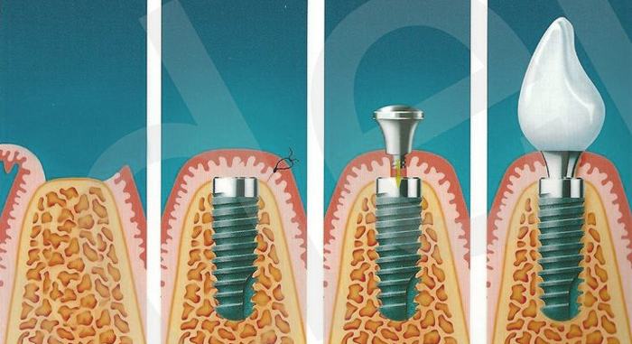 Этапы имплантации зуба пошаговое описание и фото